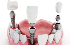 Different types of dental implants
