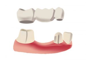 Dental bridge