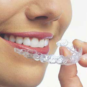 Invisalign aligners are clear and easily removed